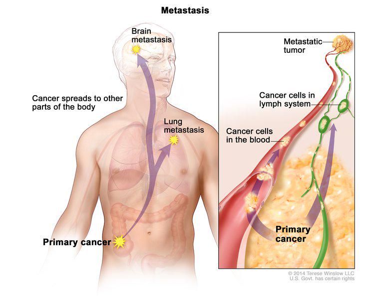 1000+ images about Cancer metastasis on Pinterest ...