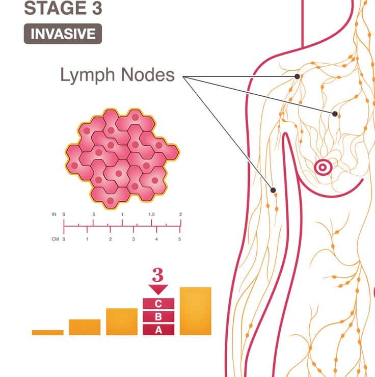 12 best lymph nodes and other detected ca images on Pinterest