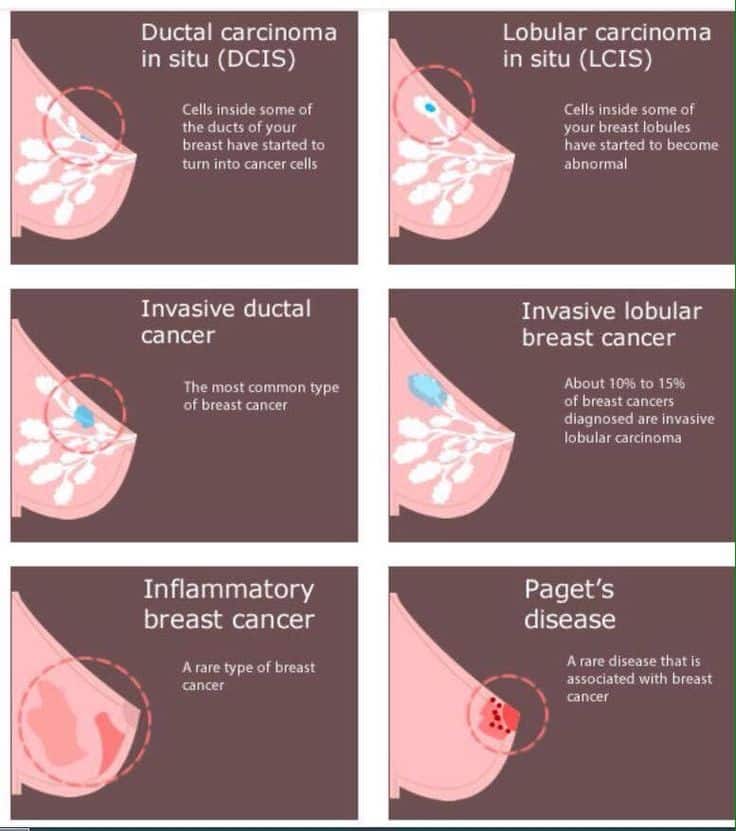 17 Best images about Mastectomy/ Breast Cancer on Pinterest
