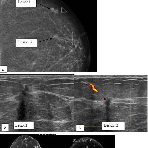 44 year old lady presented with a palpable lump in upper ...