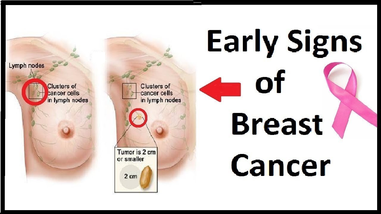 5 Early Signs Of Breast Cancer That Many Women Ignore ...