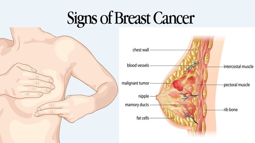 5 Signs of Breast Cancer (Aside From a Lump)