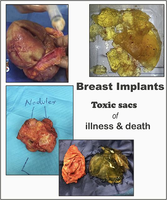 58 best Breast Implant Illness