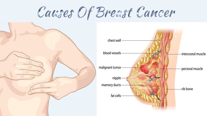 9 Symptoms And Causes Of Breast Cancer