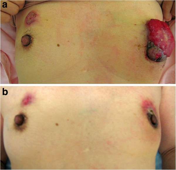 A case of synchronous bilateral breast cancer with different ...