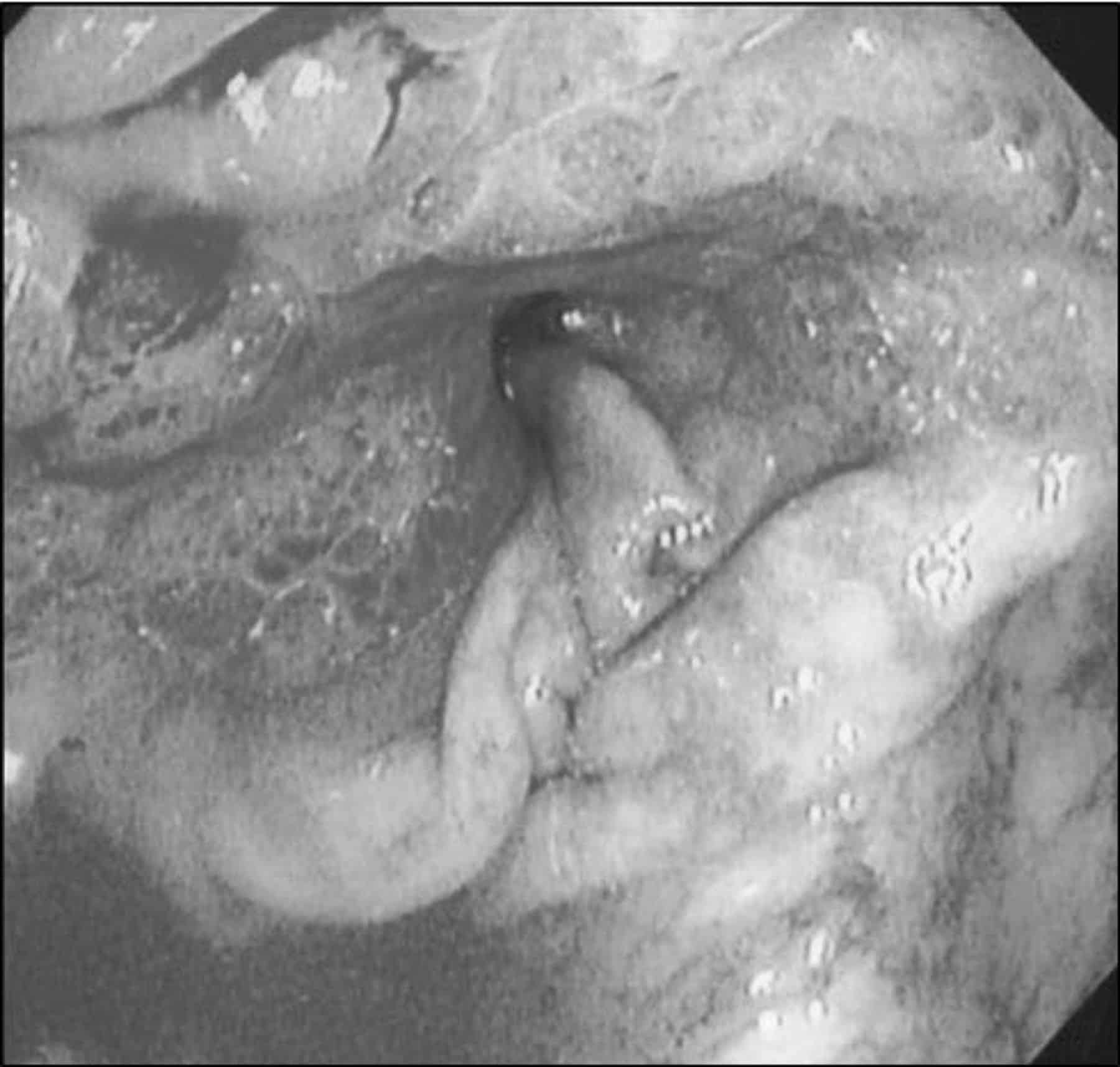 A Case of Synchronous Metastasis of Breast Cancer to Stomach and Colon ...