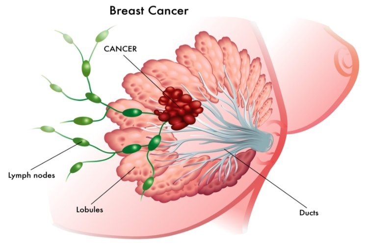 A Lump Isnt the Only Symptom of Breast Cancer. Here Are 7 ...