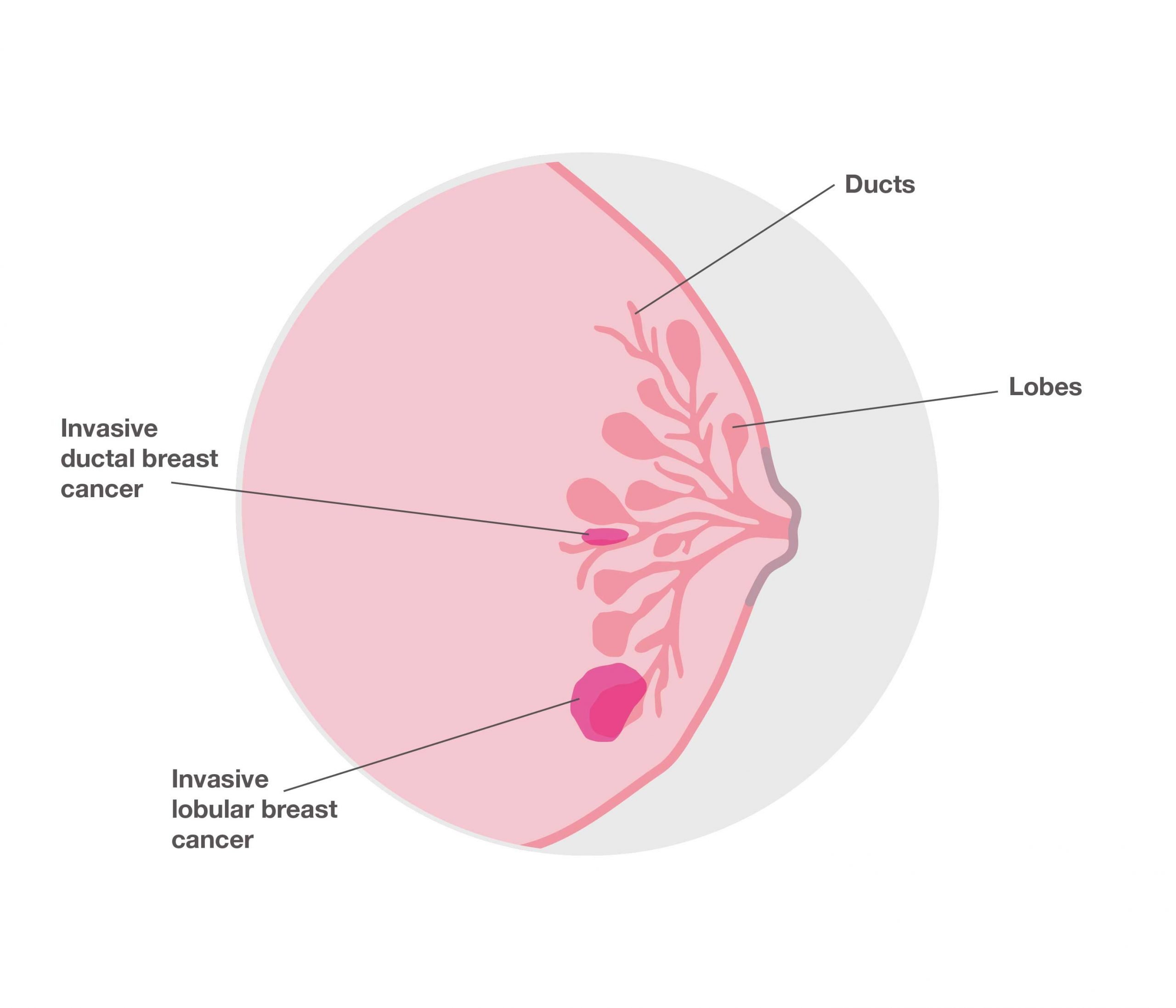A new lethal weapon against lobular breast cancer