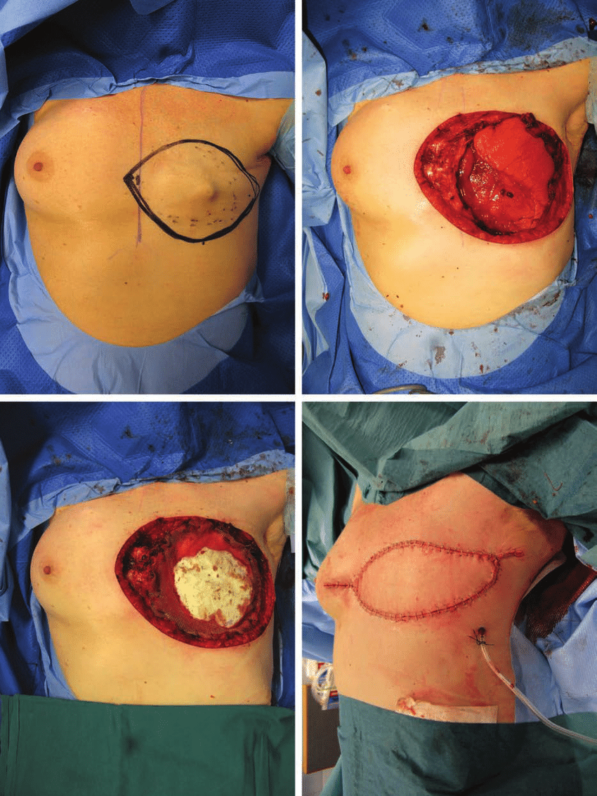 (Above, left) Chest wall recurrence of breast cancer. (Above, right ...