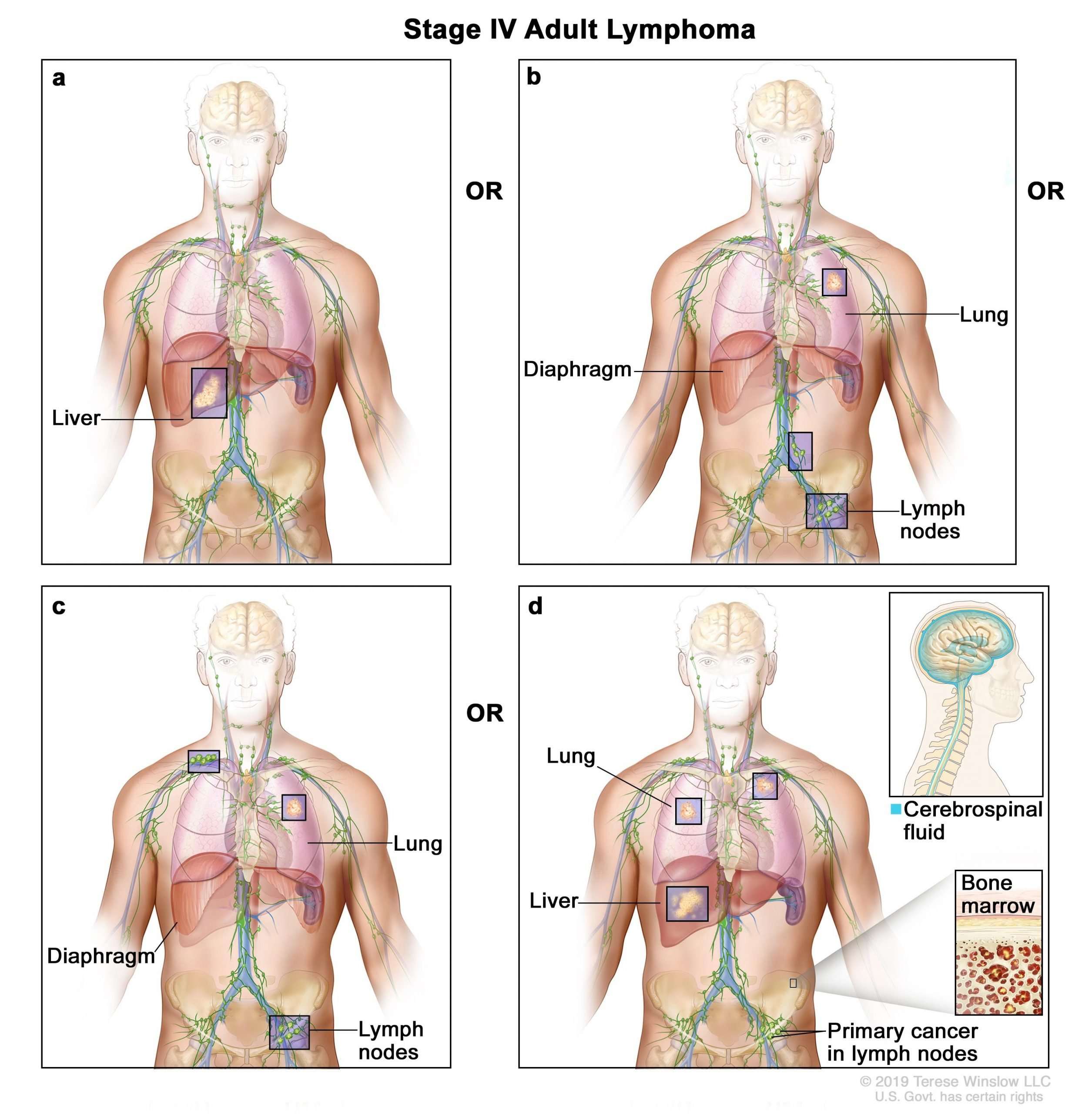 Analysis Of Kidney cancer That Has spread To The Lungs