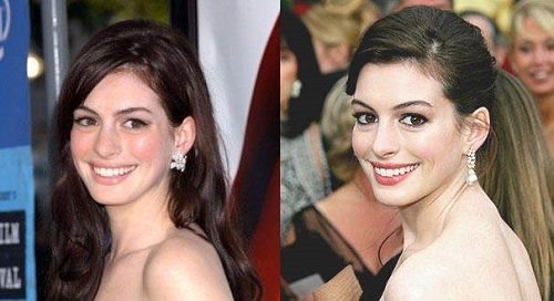Anne Hathaway Looks like has had Breast Augmentation ...