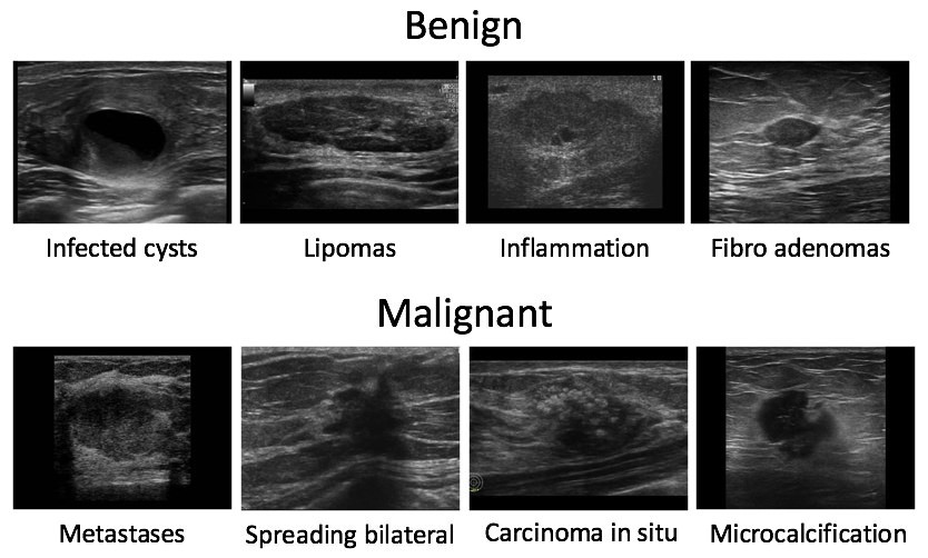 Automating Breast Cancer Detection with Deep Learning