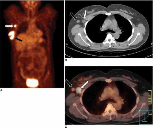 Axillary lymph node metastasis in a 45