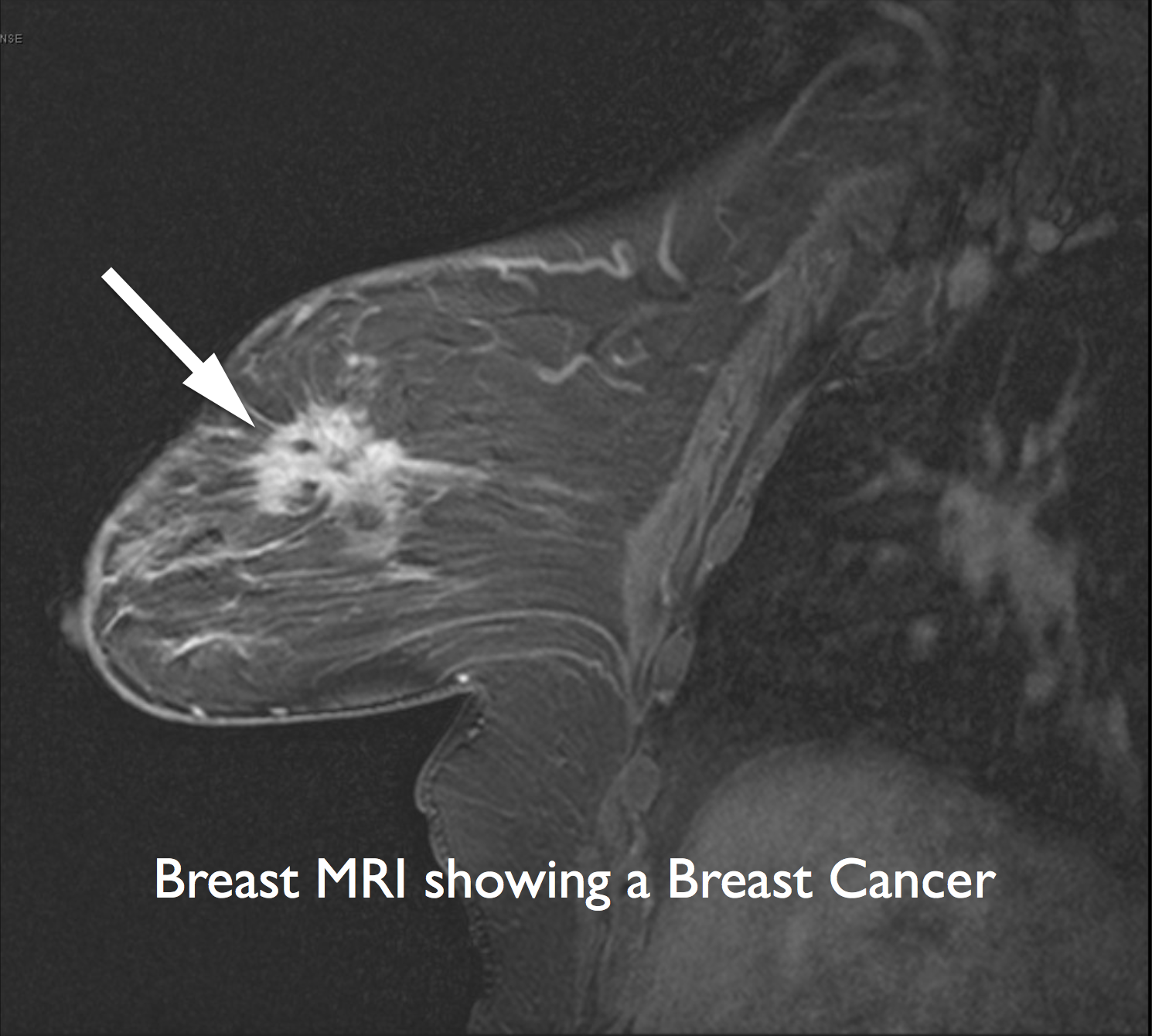 Beneath the Surface: A Guide to Breast Imaging  Breast360.org