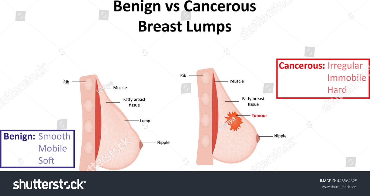 Benign Vs Cancerous Breast Lumps Stock Illustration ...