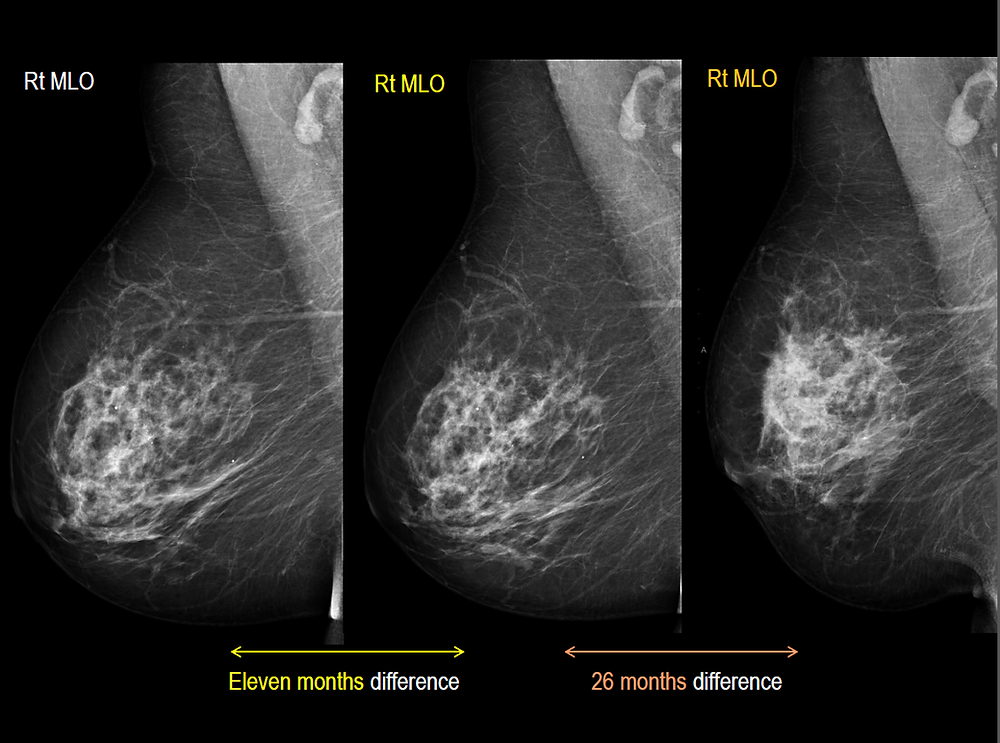 Bilateral Breast Cancer Mammography Histology Correlation