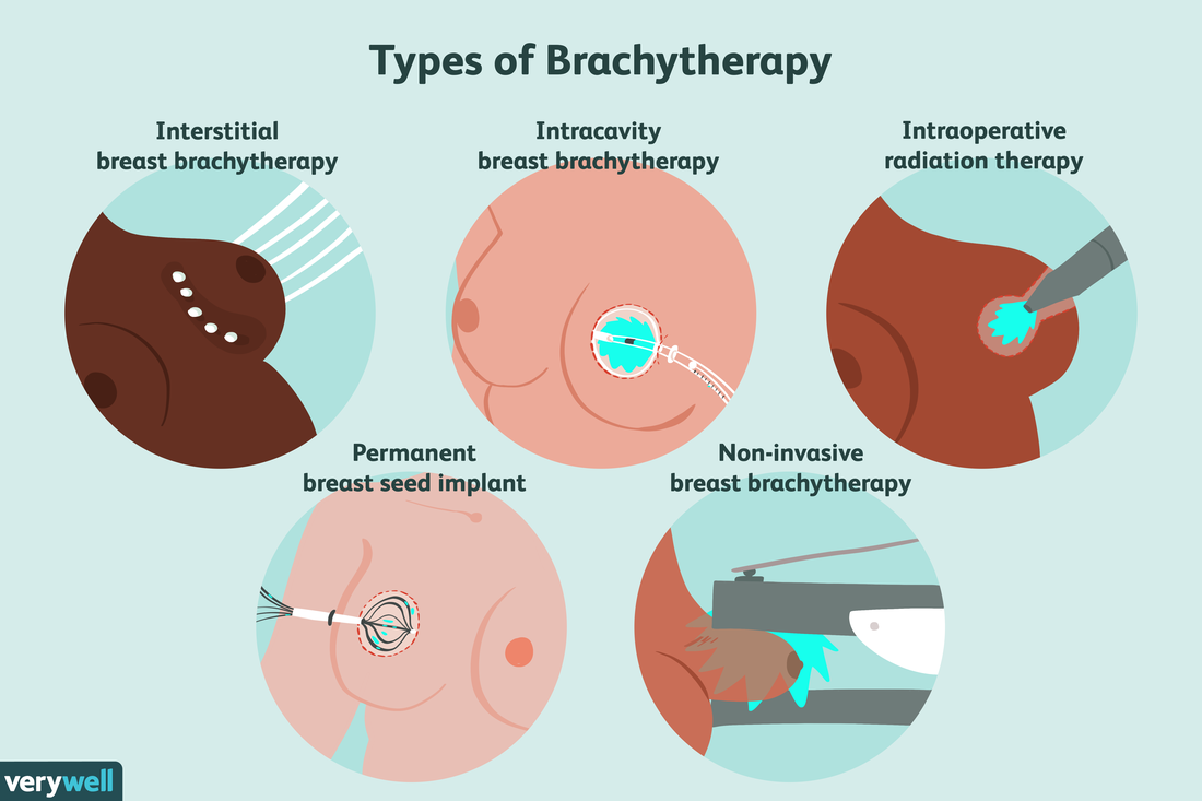 Brachytherapy for Early