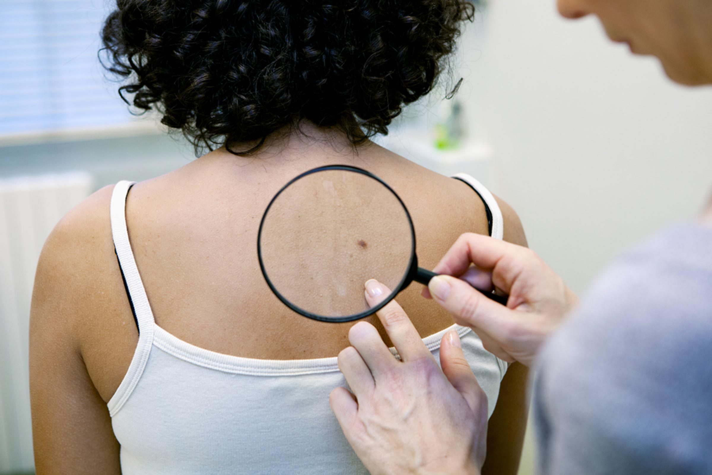 Breakthrough Melanoma Treatment Could Save Thousands of ...