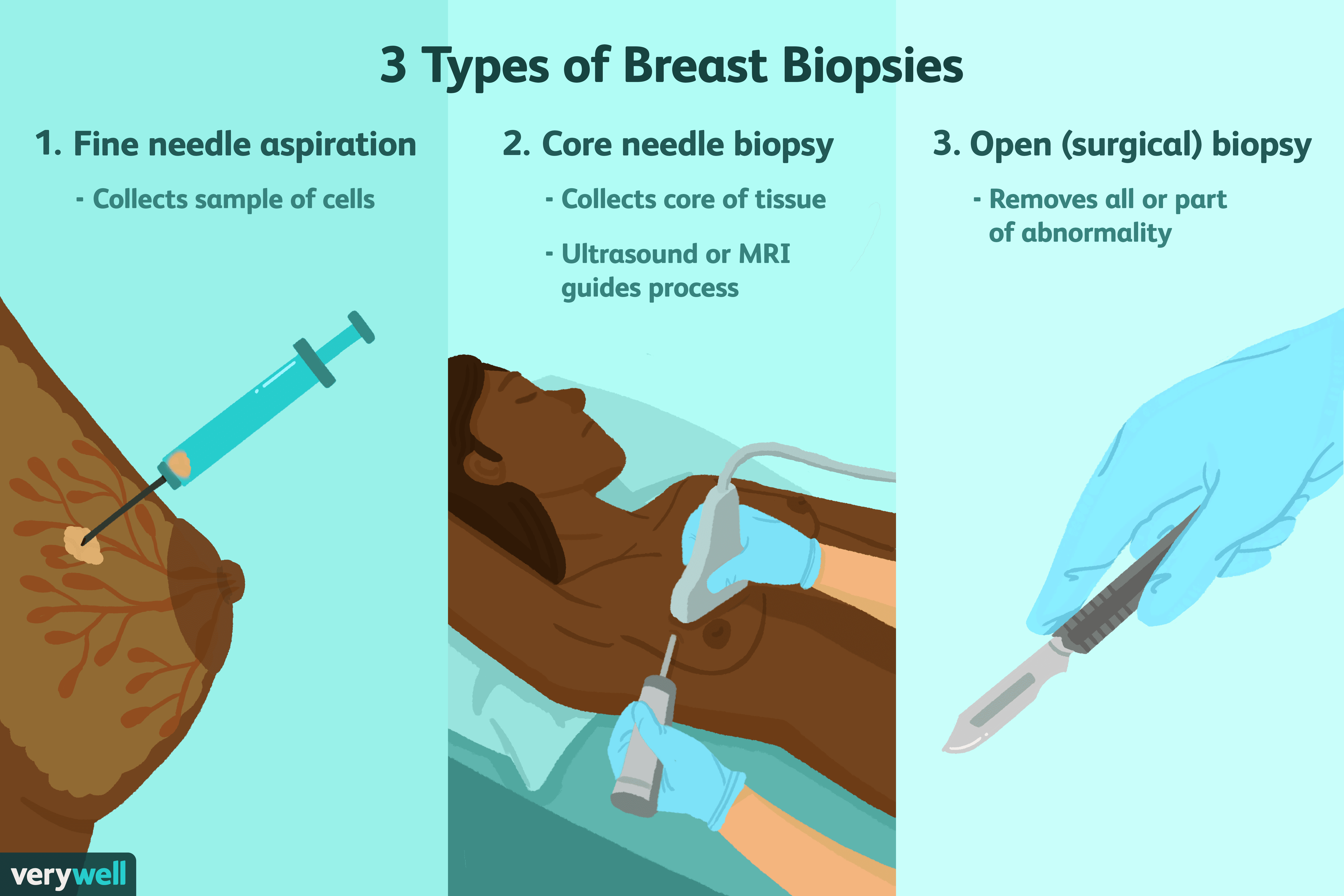 Breast Biopsy: Uses, Side Effects, Procedure, Results