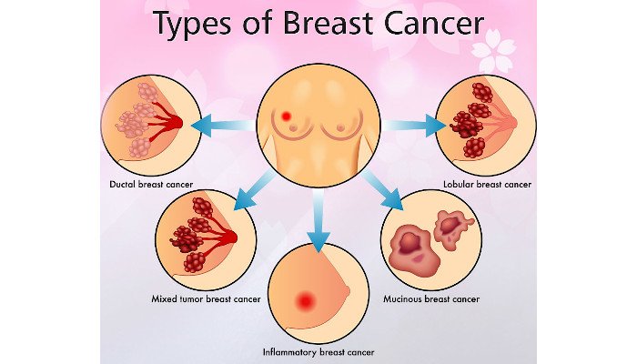 Breast Cancer Archives