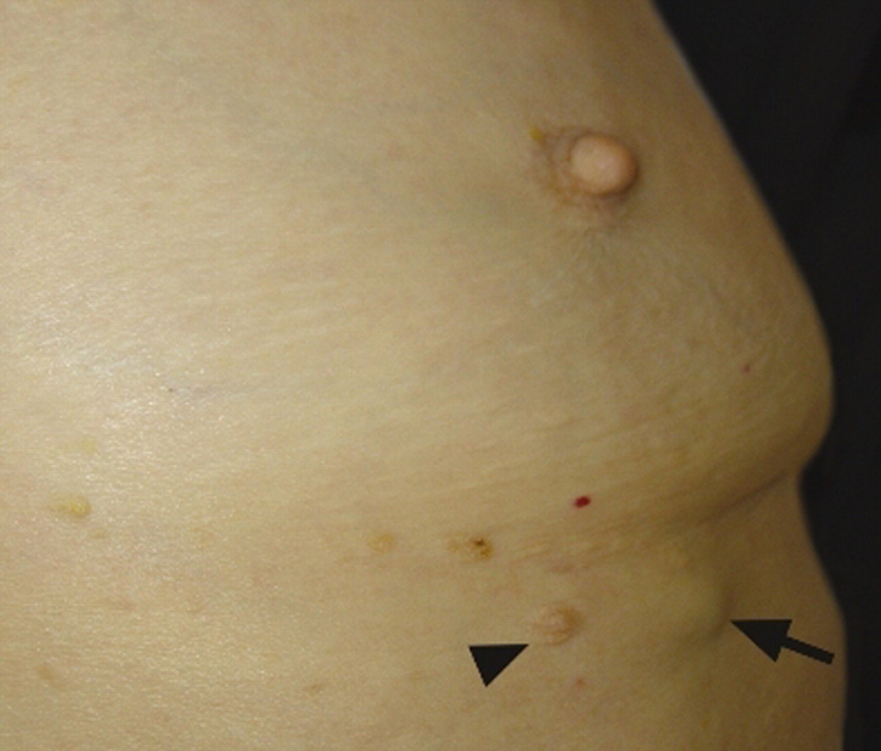 Breast cancer associated with an accessory nipple
