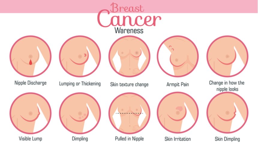 Breast Cancer Awareness: Symptoms and Signs of Breast Cancer