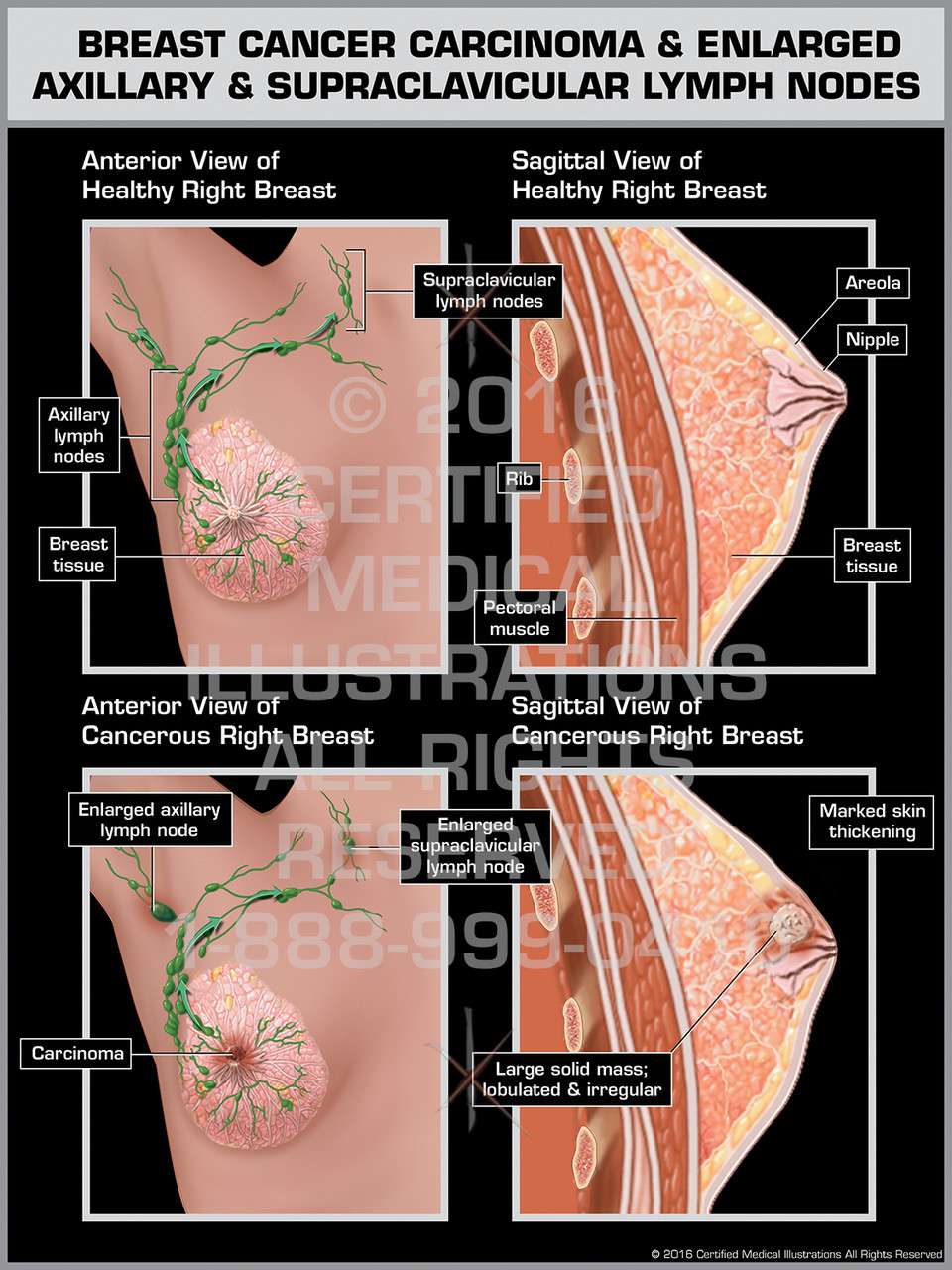 Breast Cancer Carcinoma &  Englarged Axillary &  Supraclavicular Lymph Nodes