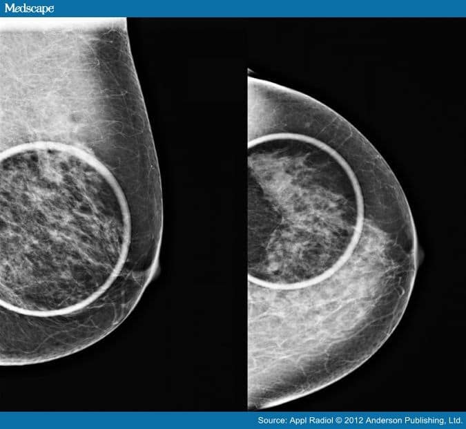 Breast Cancer Diagnosed by Tomosynthesis in Dense Breasts