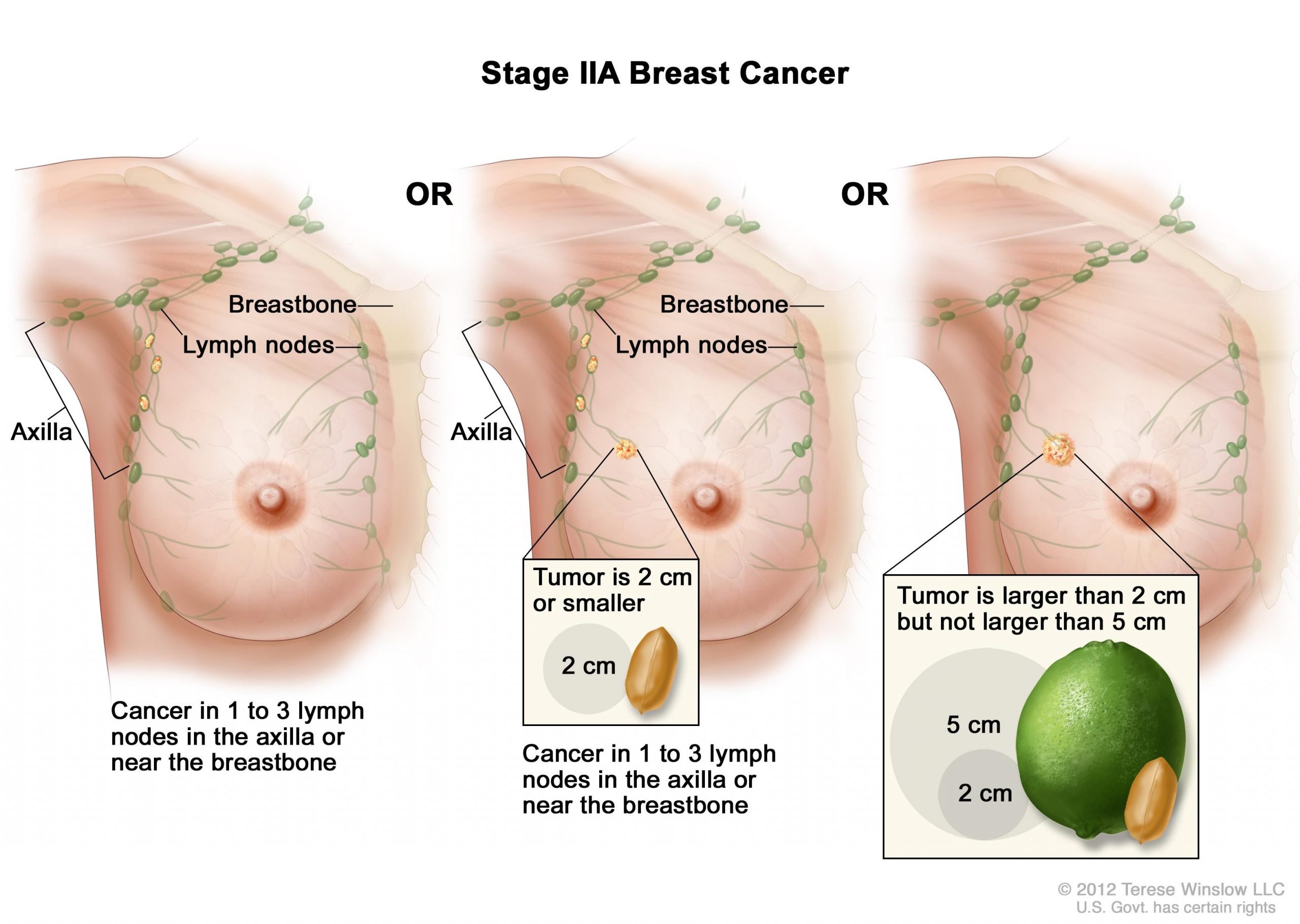 Breast Cancer During Pregnancy (PDQÂ®)âPatient Version ...
