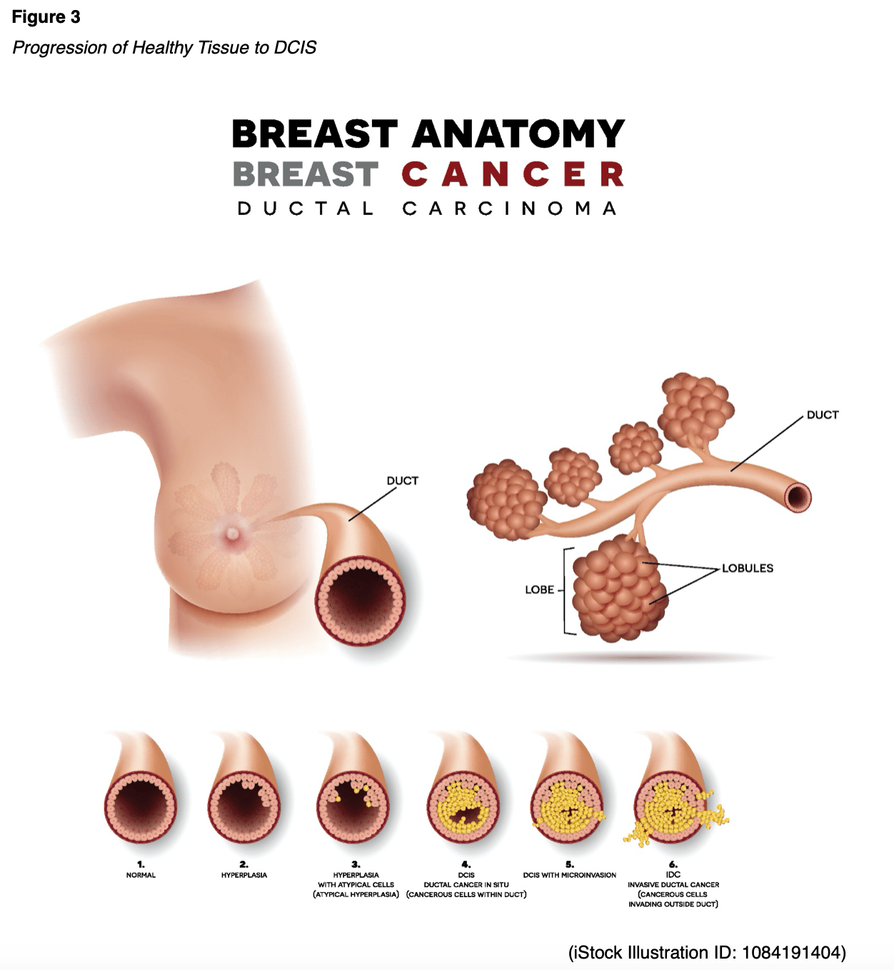 Breast Cancer for APRNs Nursing CE Course