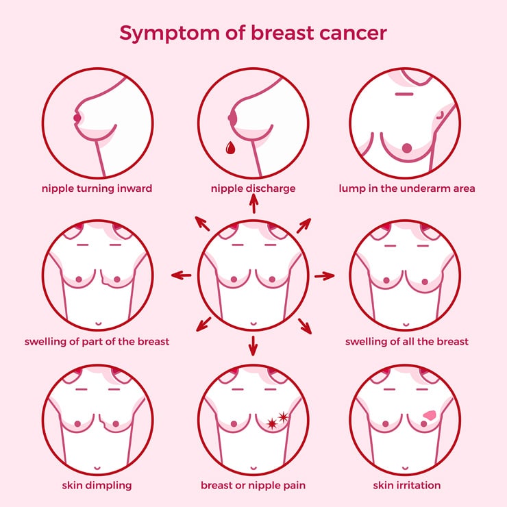 Breast Cancer in Canada: Statistics and Symptoms