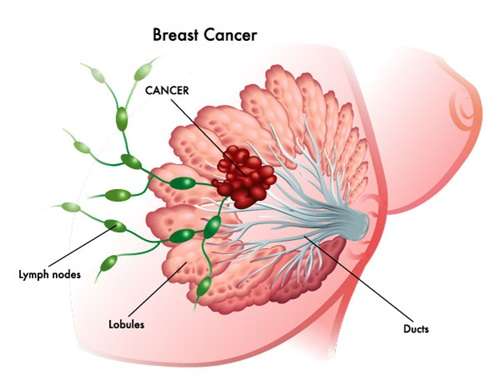 Breast Cancer Information Overview