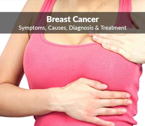 Breast cancer (Mammary gland cancer): Symptoms, Causes, Diagnosis ...