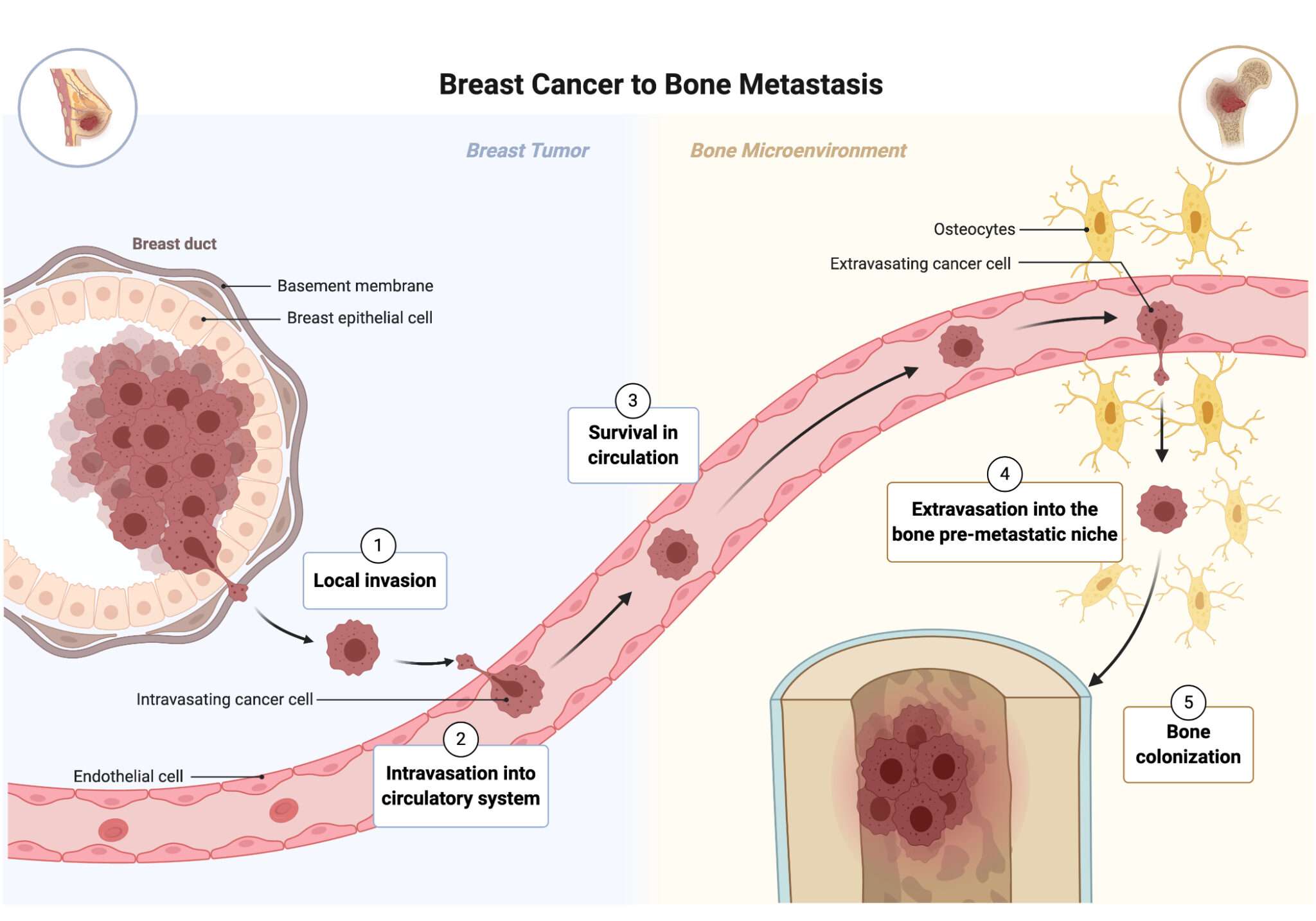 Breast Cancer Metastasis to the Bone Microenvironment