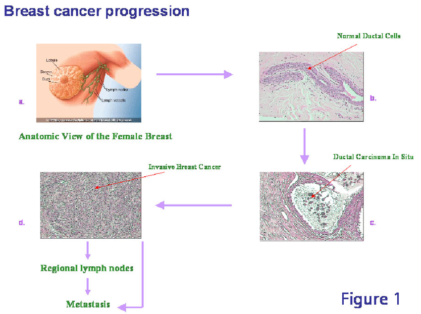 Breast cancer progression  The above figure provides a ...