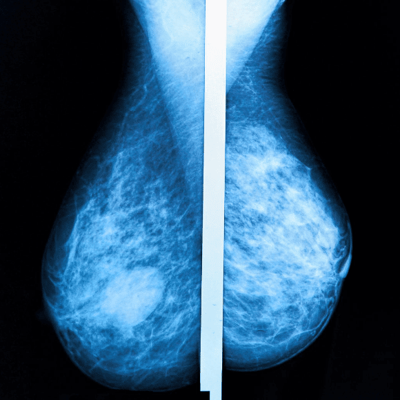 Breast cancer screening: 3D mammography shows promise
