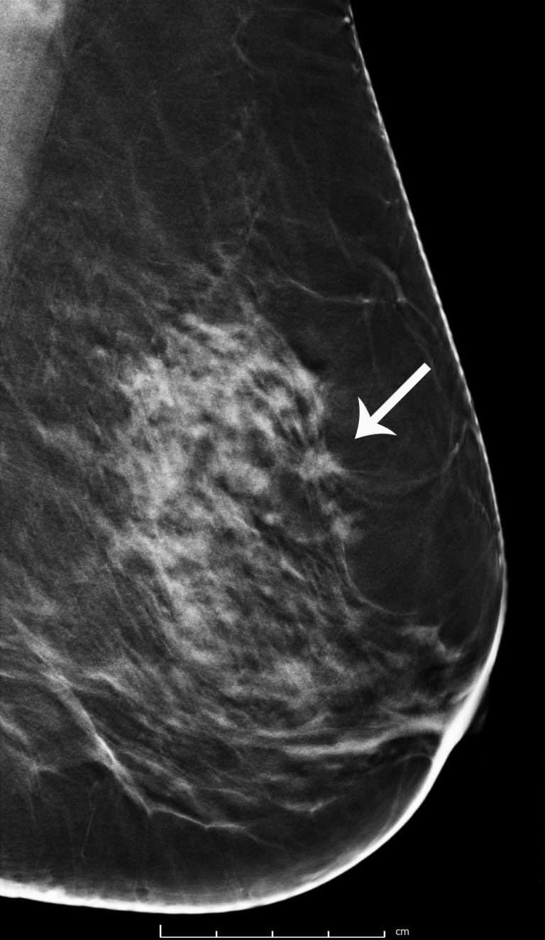 Breast Cancer Screening with 3D Mammography or Tomosynthesis ...