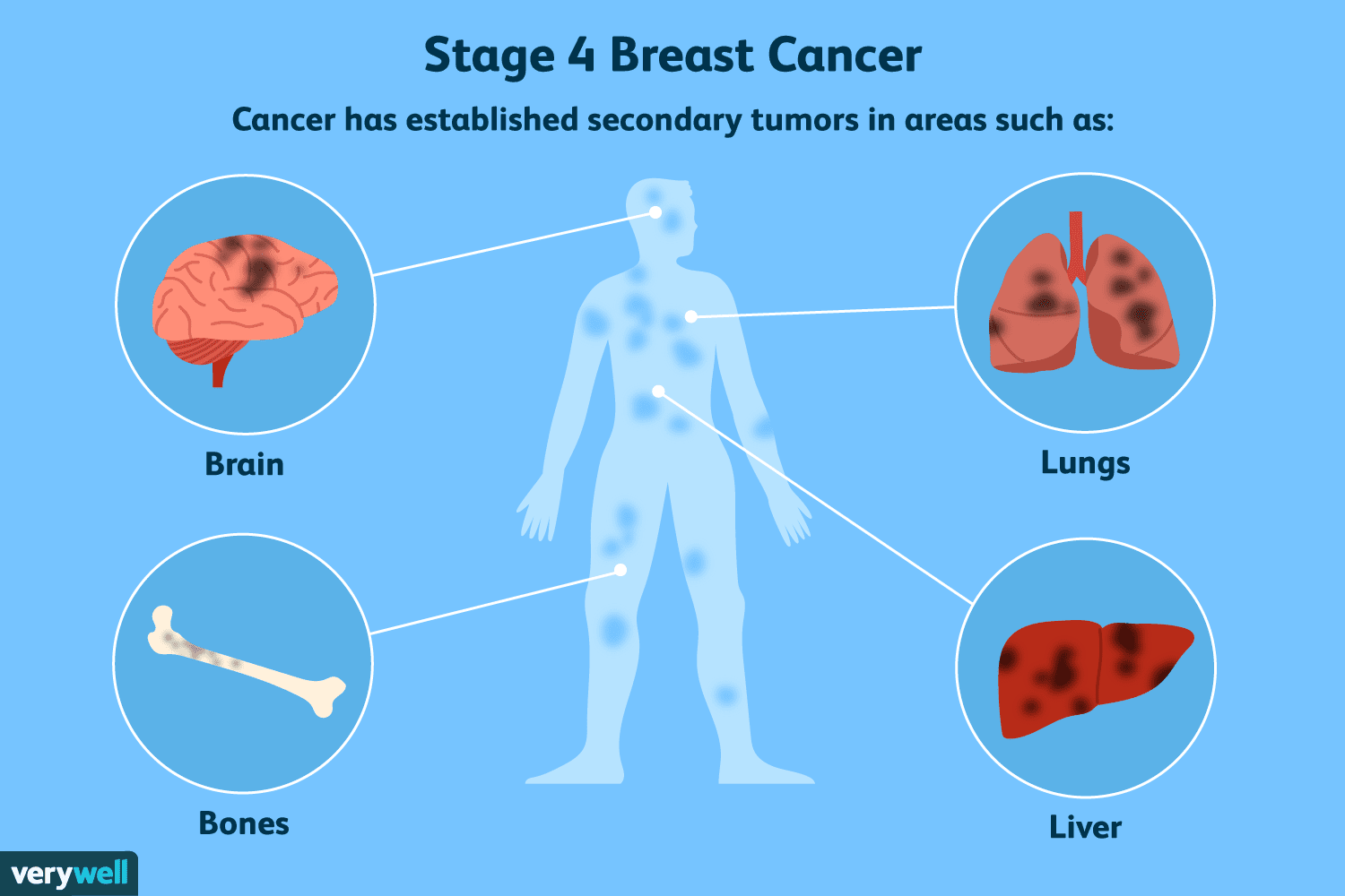 Breast Cancer Spread to the BrainSymptoms and Treatments