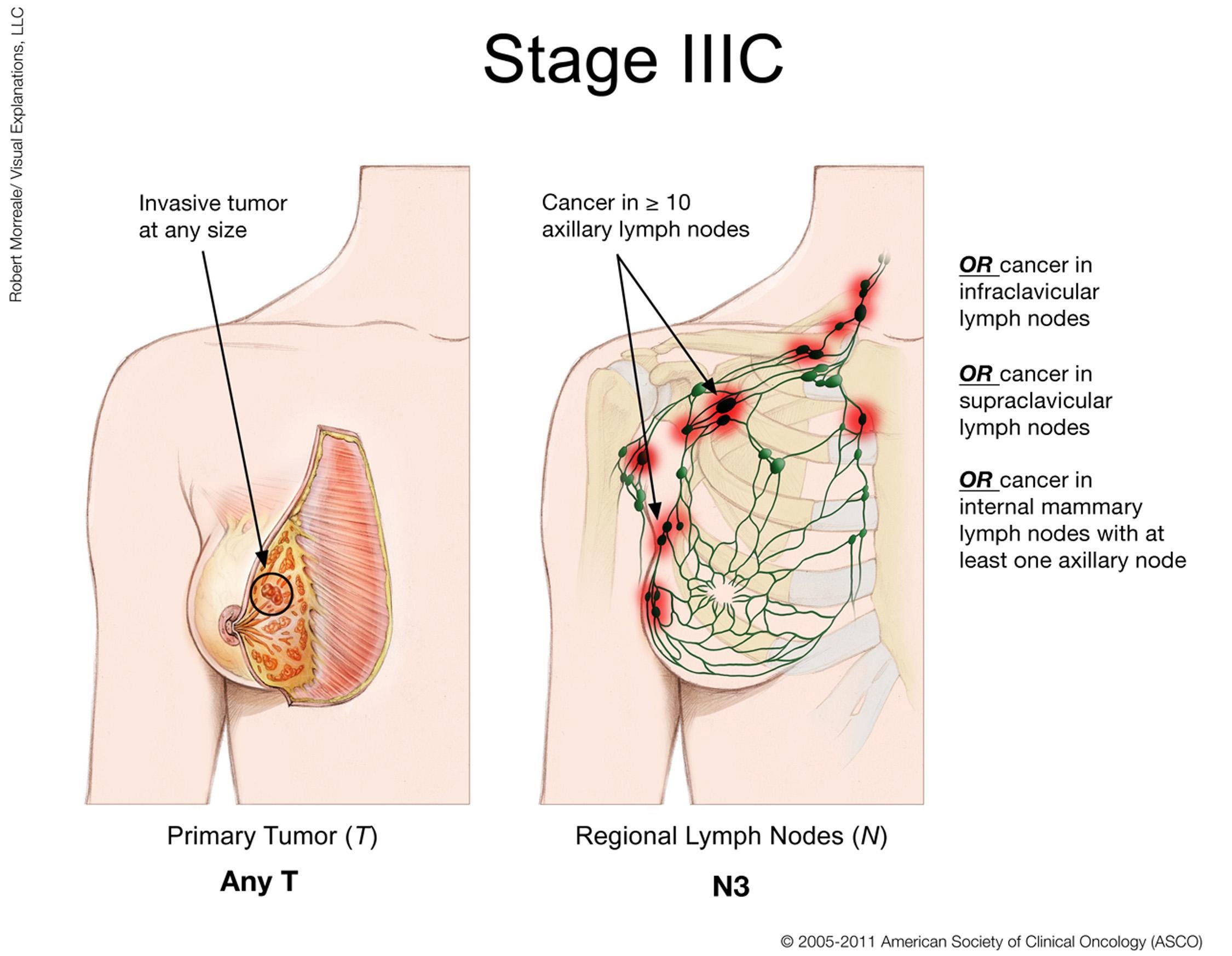 Breast Cancer (Stage IIIC)