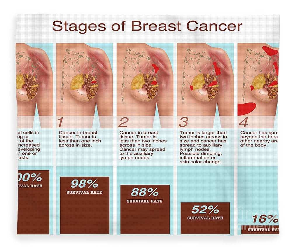 Breast Cancer Stages, Illustration Fleece Blanket for Sale by Gwen Shockey