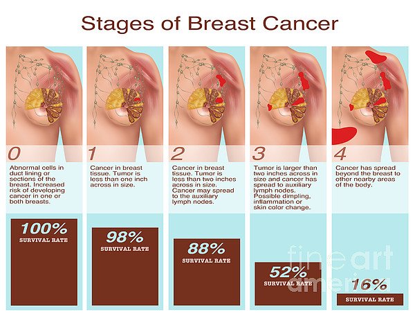 Breast Cancer Stages, Illustration Greeting Card for Sale ...