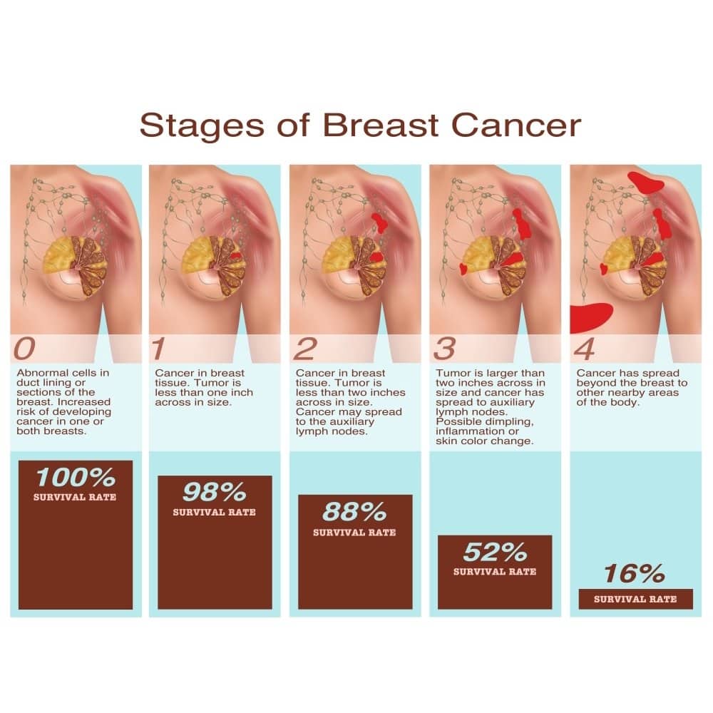 Breast Cancer Stages Illustration Poster Print by Gwen ShockeyScience ...