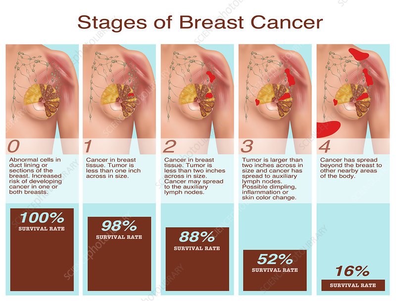 Breast Cancer Stages, Illustration