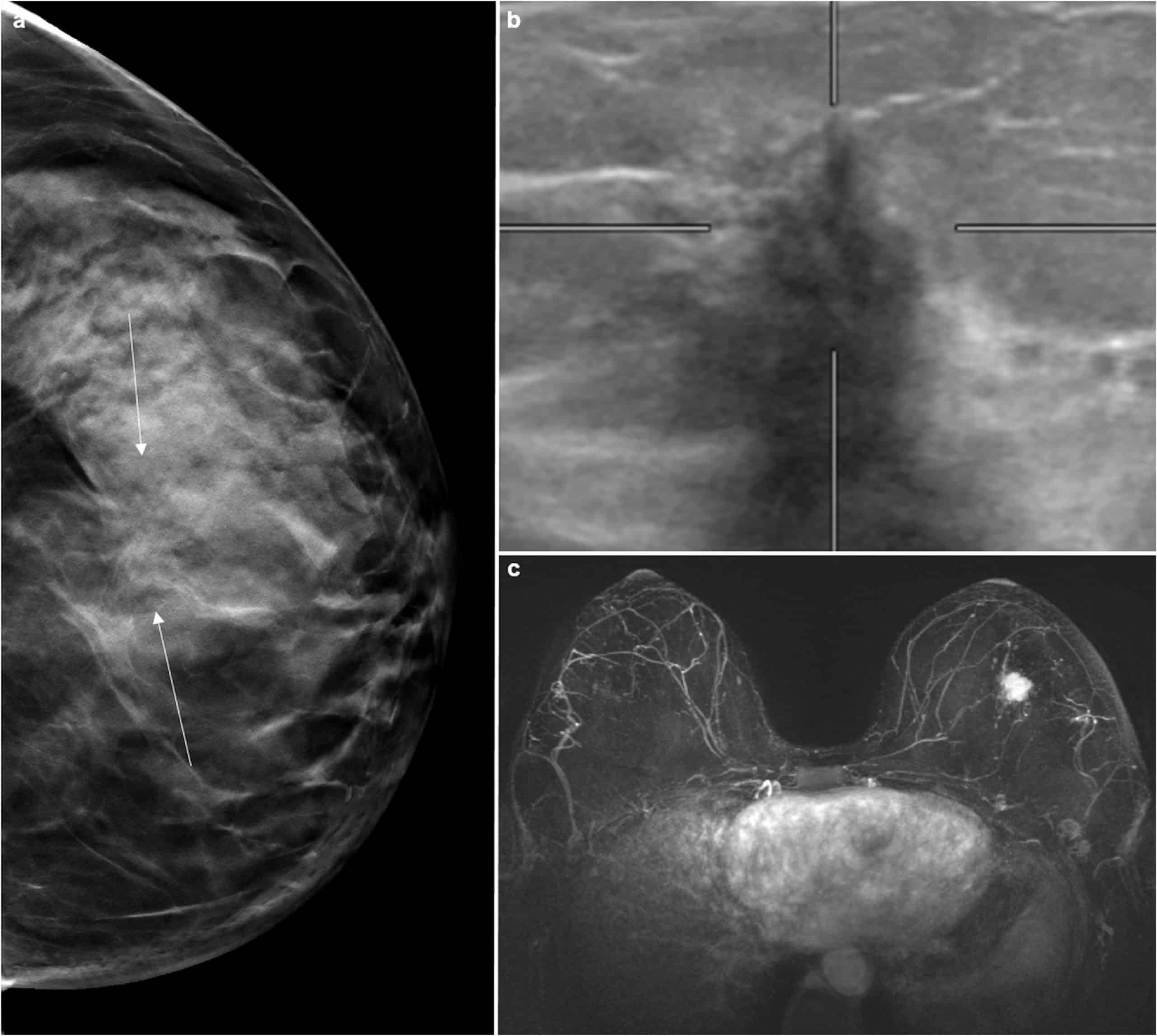 Breast cancer staging: Combined digital breast tomosynthesis and ...