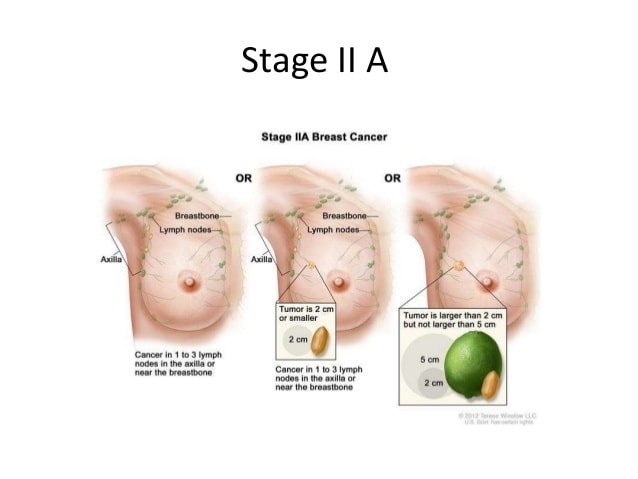 Breast cancer staging
