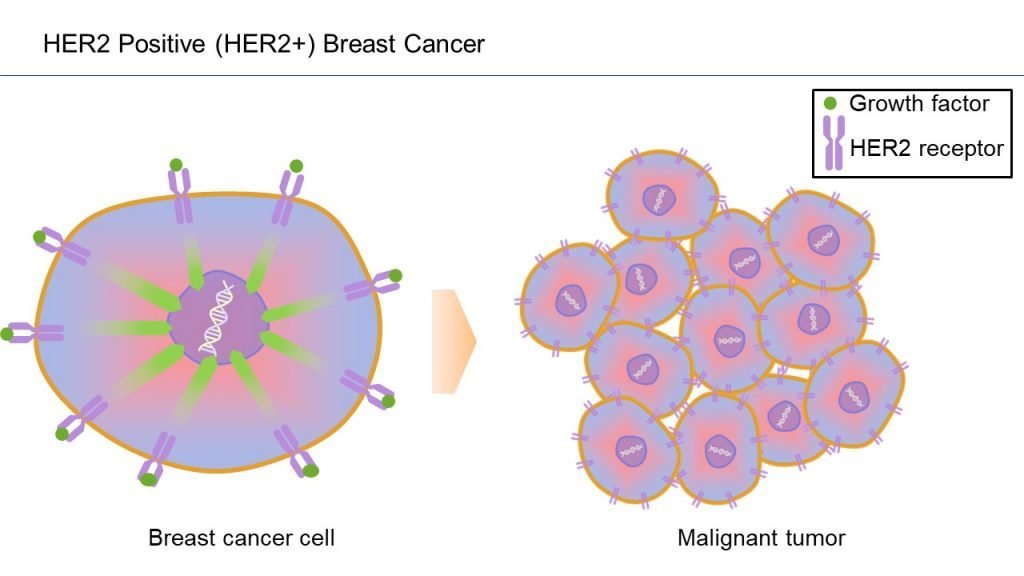 Breast Cancer Subtypes