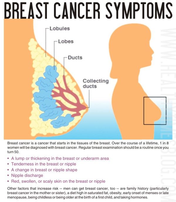 Breast cancer symptoms and pregnancy.