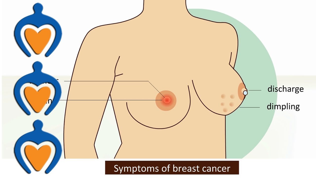 Breast cancer