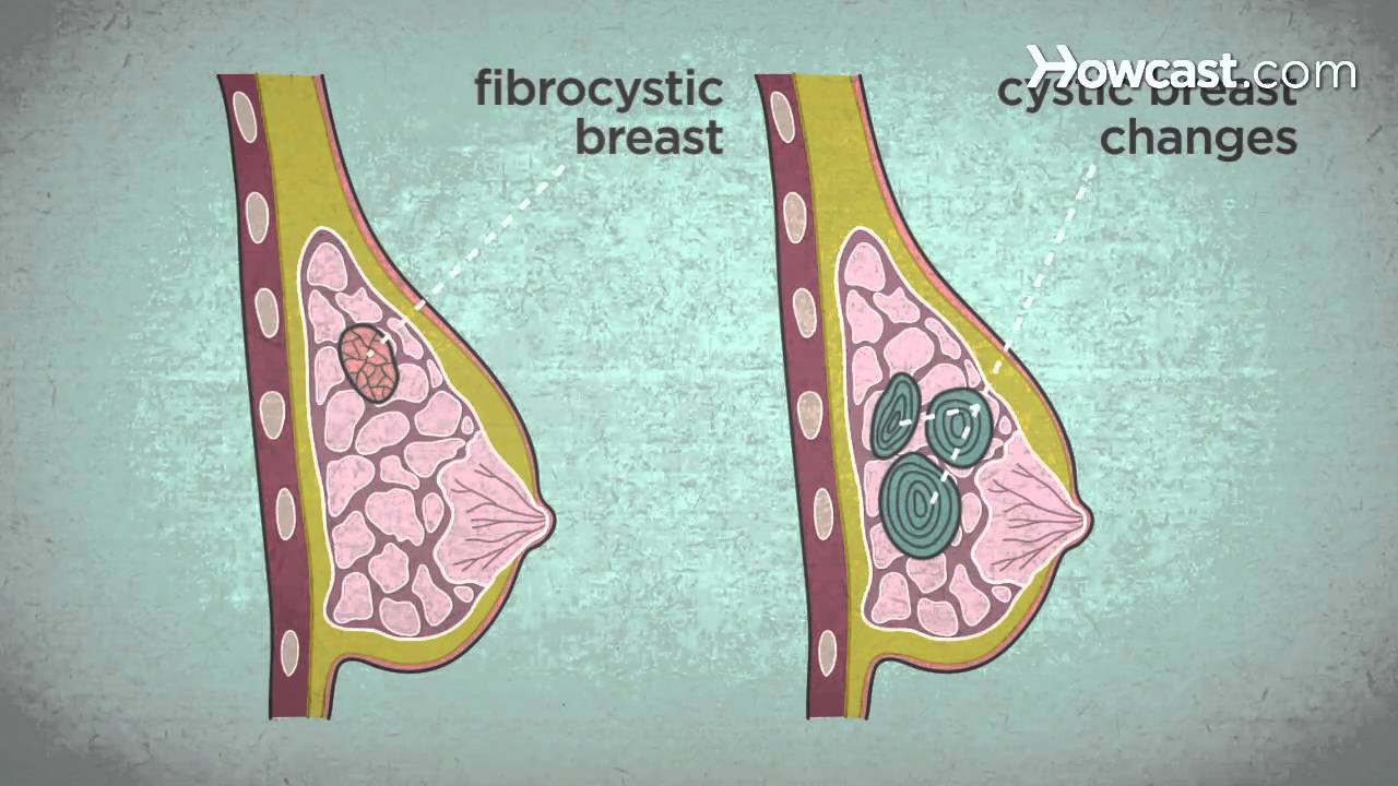 BREAST CANCER SYMPTOMS EVERYONE NEEDS TO KNOW