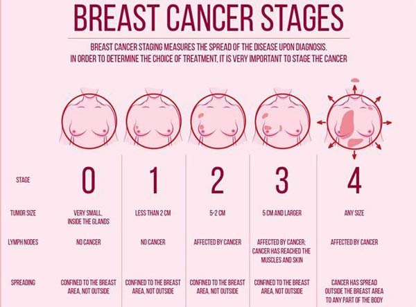 Breast Cancer, The Most Common Kind of Cancer in Women
